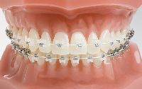 Ceramic Braces