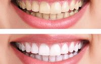 tooth bleaching