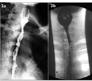 Barium Swallow Test Service