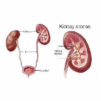 kidney stone treatment services