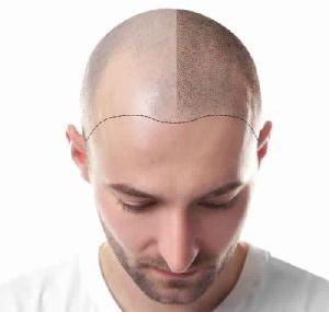 Hair Transplantation Treatment Services