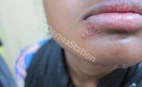 Herpes Simplex Treatment