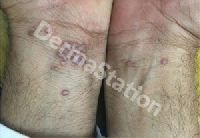 Lichen Planus Treatment