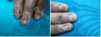 Nail Diseases Treatment