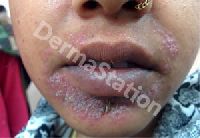 Perioral Dermatitis Treatment