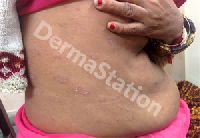 Pityriasis Rosea Treatment