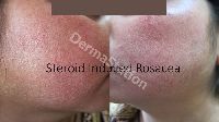 Rosacea Treatment