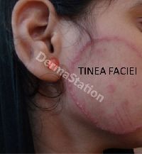 Tinea Treatment