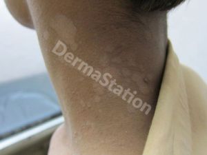 Tinea Versicolor Treatment