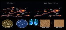 Abnormal Sperm Infertility