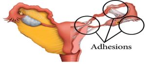 Ashermans Syndrome Treatment