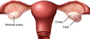 Ovarian Cyst Treatment