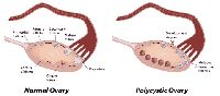 Polycystic Ovarian Disease Treatment