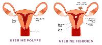 Polyps Treatment