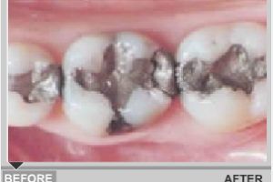 White Fillings Services