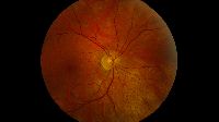 Optic Nerve Hypoplasia Stem Cell Treatment Services