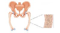 Osteomalacia Stem Cell Treatment Services