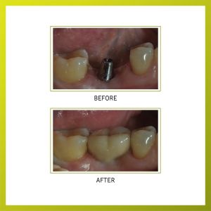 dental implant restoration