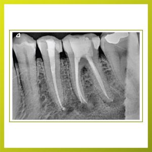 Root Canal Treatment