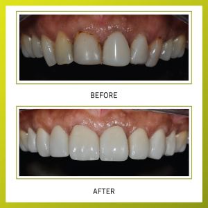 veneers treatment