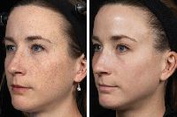 Pigmentation Management