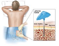 Acute Lymphocytic Leukemia Treatment (Adult)