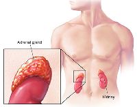 Adrenocortical Carcinoma Treatment (Adult)