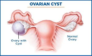 Ovarian Cyst Removal