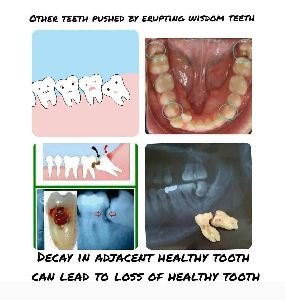 WISDOM TOOTH SURGERY