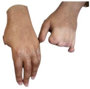 Silicone Hand Prosthesis