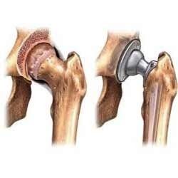Hip Replacement Treatment