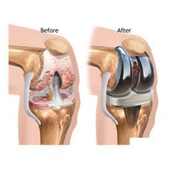 Knee Replacement Treatment