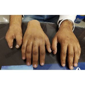 Silicone Hand Prosthesis