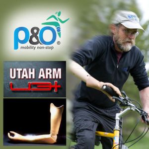 Arm Prostheses