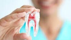 root canal treatments