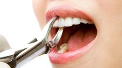 wisdom tooth extraction services