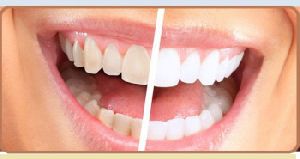 Laser instant Teeth Whitening treatment in Delhi