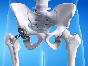 hip replacement