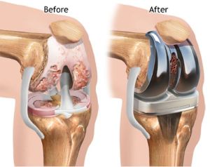 Total Knee replacement in Dahisar