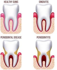 Gum Care treatment