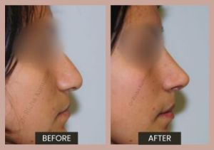 Nose Reshaping