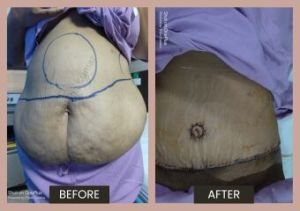 Tummy tuck treatment