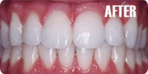 Whitening/Dental (Teeth) Bleaching