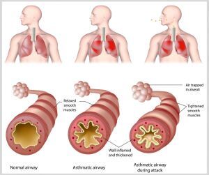 Asthma and Allergy Treatment