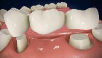 dental crown bridges