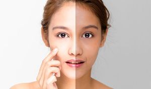 skin whitening treatment