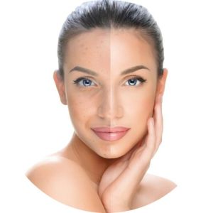 Dull Skin Treatment