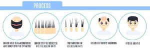 Follicular Unit Transplant