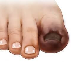 Fungal Toenail Treatment