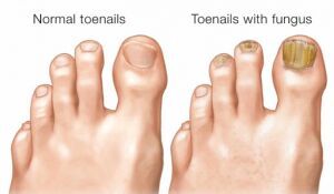 Fungal Toenails Treatment